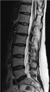 MRI spine