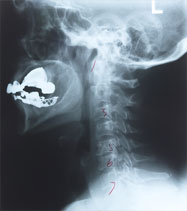 x-ray